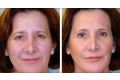 ​Мезонити: отзывы, фото до и после подтяжки лица, лечение 8