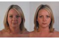 ​Мезонити: отзывы, фото до и после подтяжки лица, лечение 4