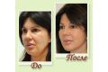 ​Мезонити: отзывы, фото до и после подтяжки лица, лечение 9
