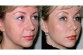 ​Мезонити: отзывы, фото до и после подтяжки лица, лечение 11