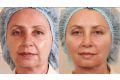 ​Мезонити: отзывы, фото до и после подтяжки лица, лечение 10