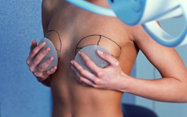 Увеличение груди, Грудные импланты, увеличение
